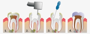 Root Canal Therapy Is Required When A Tooth Is Infected - One Visit Root Canal