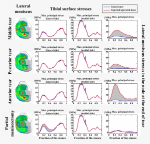 Effects Of Radial Tears And Partial Meniscectomy On - Diagram