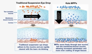 This Graphic Is Included For Illustrative Purposes - Kala Pharmaceuticals