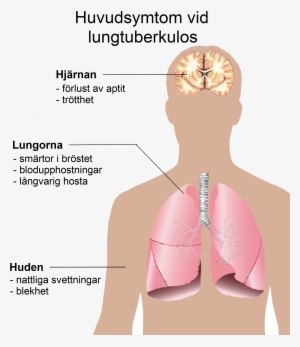 Pulmonary Tuberculosis Symptoms Swedish - Symptoms Of Tuberculosis