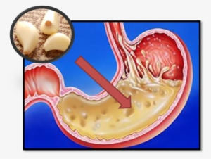 Esto Es Lo Que Pasa Cuándo Te Comes Un Ajo Con El Estómago - Neutralize Stomach Acid