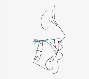 -measure Of Upper Lip Height - Anterior Nasal Spine