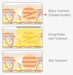 Laser Skin Tightening Exeter Medical Before, During - Calligraphy