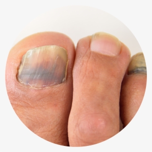 Subungual Nail Circle