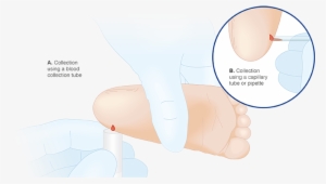 Expert Tip - Capillary