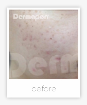 Dermapen For Acne Scars - Text