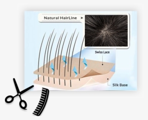Hair Replacement For Men-hair Loss Solutions Newhairline - Hair Transplantation