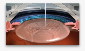 Laser Cataract Surgery - Surgery Cataract