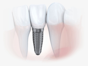 Animation Of Implant Supported Dental Crown - Dental Implant