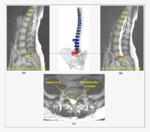 Mri Of The Lumbar Sacral Spine Of A 16 Year Old Boy - Spinal Disc Herniation