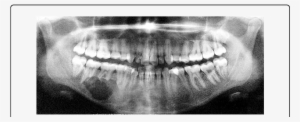 Orthopantomogram Unilocular Radiolucency With Scalloped - Radiography