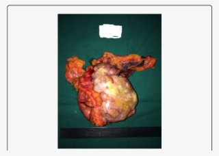 Gross Picture Of The Tumour - Low Grade Endometrial Stromal Sarcoma
