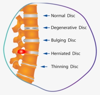 Degenerative Disc Disease - Disc Spine