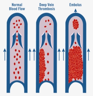 Vein Healthcare Center - World Thrombosis Day 2017