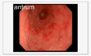 Endoscopy Showing Erythematous Gastric Nodules In The - Erythematous Patches In Stomach