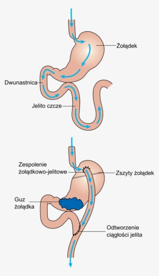 Diagram Showing Before And After Stomach Bypass Surgery - Antrum Żołądka Gdzie