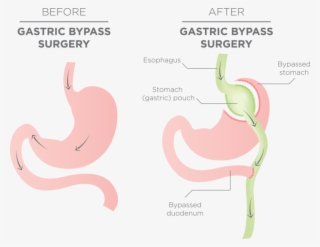 The Upper Is Bypassed Directly To The Small Intestine - Gastric Bypass