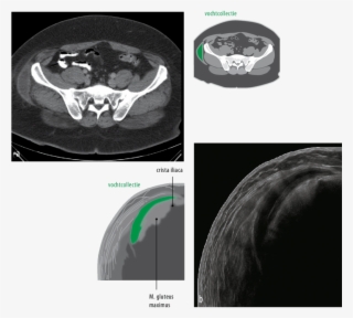 Figuur 1 Een Transversale Ct-coupe Van Het Abdomen - Computed Tomography
