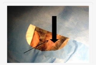 Thin Arrow Indicates The Former Scar After A Non Skin - Surgery