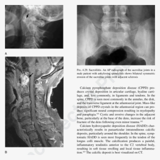 A Lateral Radiograph Shows Widening Of The Atlantoaxial - Atlantoaxial Joint Rheumatoid Arthritis