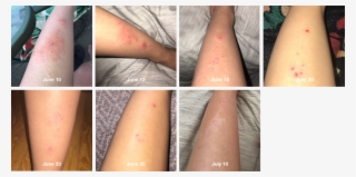 This Is My Leg Now From The Poison Ivy - Health Care