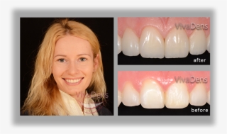 Why To Choose Direct Aesthetic Restoration Procedure - Tooth Bleaching