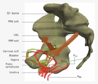 Sagittal Slices Measuring The Bladder Base And The - Pectopexy