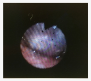 The Fiberoptic Was Placed In The Right Naris And Advanced - Light