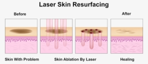 Acne Sometimes Feels Like A Double Punishment- First - Icon 1540 Fractional Laser