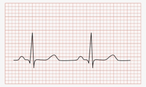 Open - Normal Ecg