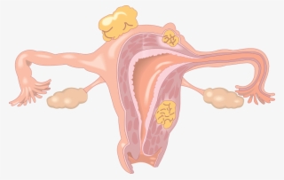 Signs Of Endometriosis - Fertility Disorder