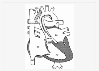 In Stage I, Norwood Procedure, The Pulmonary Artery