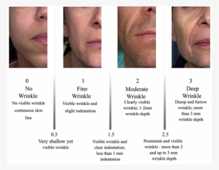 Reference Photographs Of The Four Main Classes For - Fitzpatrick Wrinkle Scale