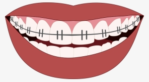 Orthodontics, Smile, Teeth, Dentist - Mouth Braces Transparent Background Clipart