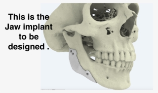 Jaw Implant Idea - Danger This Is Sparta