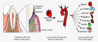 Oral Bacteria Systemic Diseases