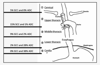 Incidence And Location Of The Two Types Of Esophageal - Diagram