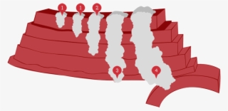Stage Ii Cancer Has Grown - Illustration