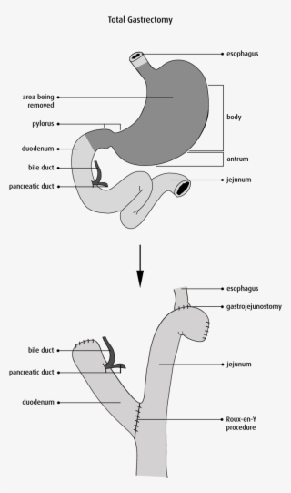 Lymph Node Dissection - Diagram