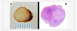 A) Tumor Is Solid, Well Circumscribed, And Yellow Tan - Lobulation