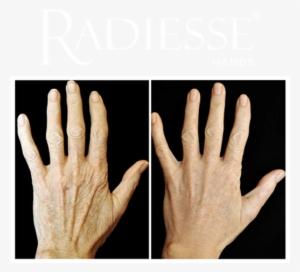 Before And After Treatment With Radiesse® Hands - Thermage Hands Before After
