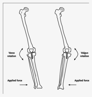 Direction Of Force Application And The Resulting Motion - Valgus Varus Force