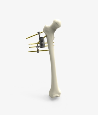 The Fixator Allows 360 Degree Rotational Motion, Flexion - Trumpet