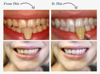 White Teeth Png - Do I Whiten My Teeth