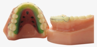Hawley Retainer With Labial Bow Soldered To Adams Clasps - Retainer