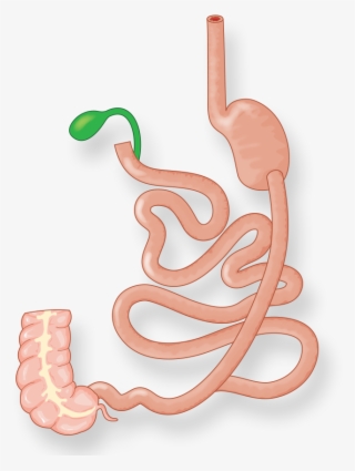 Illustration Of Intestines And Stomach After Duodenal - Duodenal Switch