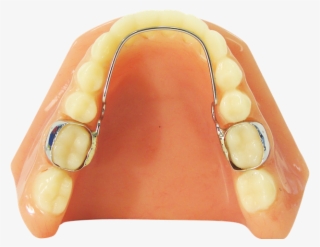 Nance Appliance - Llha Orthodontic Appliance