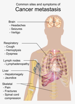 Symptoms Of Cancer Metastasis