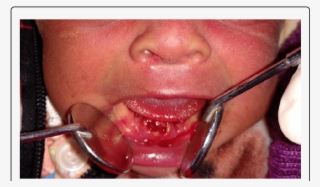 Extracted Natal Teeth Resembling Immature Teeth Download