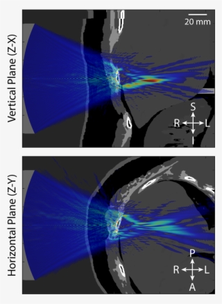 Ultrasound Beam Distortion